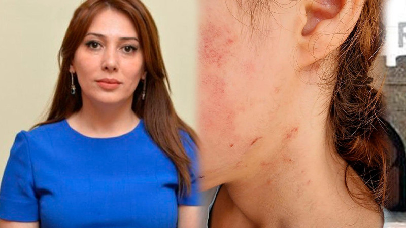 Lənkəran: ŞİH başçısının müavini tərəfindən döyülən məktəbliyə psixoloji dəstək göstəriləcək