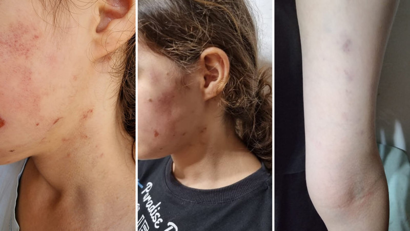 Döyülən məktəblinin anası: Rəsilə Əliyeva uşağımı ölümcül vəziyyətə salıb