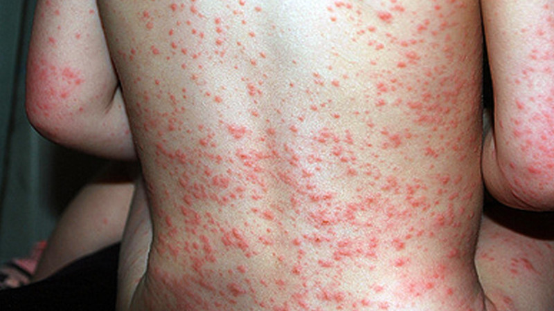 Cəlilabadda üç tələbə qızılcaya yoluxub