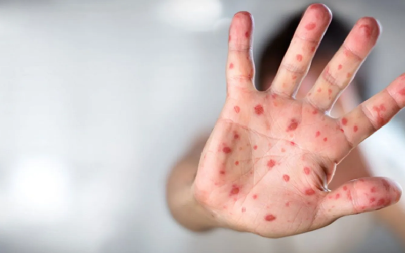 Meymunçiçəyinə yoluxan şəxs evə buraxılıb