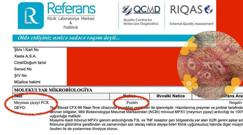 Azərbaycanda ilk meymunçiçəyi diaqnozu qoyan həkimdən PAYLAŞIM – FOTO