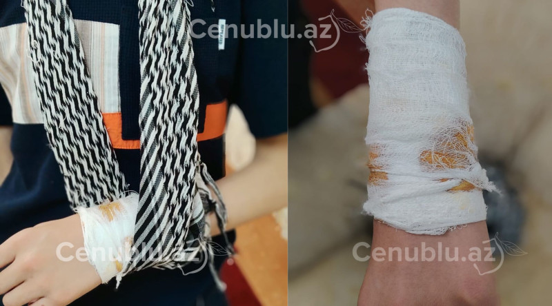 Cəlilabadda növbəti it hücumu: bu dəfə yeniyetməni dişlədi