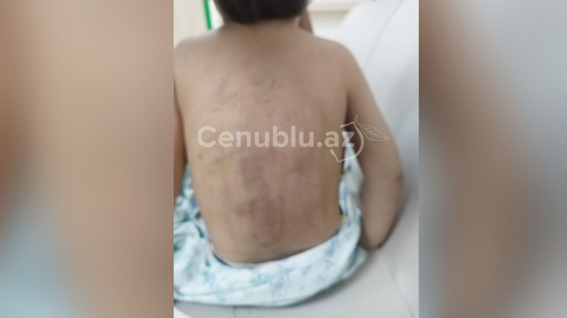 Lənkəranda 3 yaşlı uşaq atalığı tərəfindən döyülüb