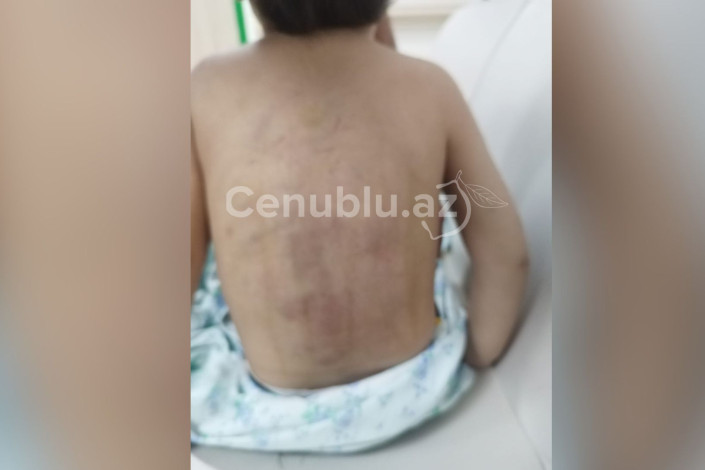 Lənkəranda 3 yaşlı uşaq atalığı tərəfindən döyülüb