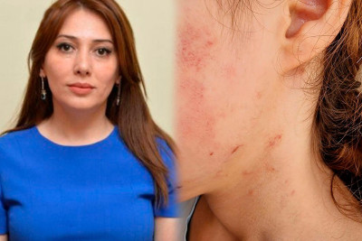 Lənkəran: ŞİH başçısının müavini tərəfindən döyülən məktəbliyə psixoloji dəstək göstəriləcək
