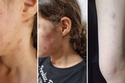 Döyülən məktəblinin anası: Rəsilə Əliyeva uşağımı ölümcül vəziyyətə salıb