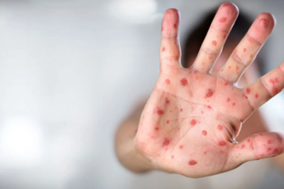 Meymunçiçəyinə yoluxan şəxs evə buraxılıb