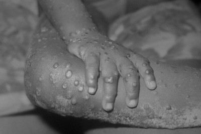 Azərbaycanda bir nəfərdə meymunçiçəyi virusu aşkarlanıb – RƏSMİ