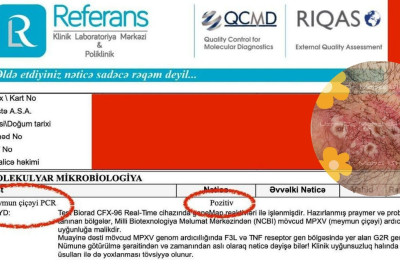 Azərbaycanda ilk meymunçiçəyi diaqnozu qoyan həkimdən PAYLAŞIM – FOTO
