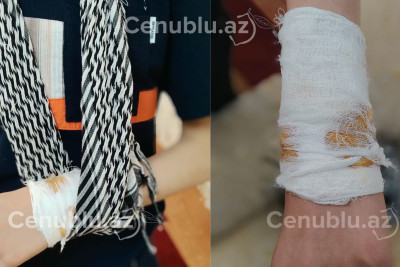 Cəlilabadda növbəti it hücumu: bu dəfə yeniyetməni dişlədi