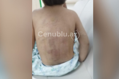 Lənkəranda 3 yaşlı uşaq atalığı tərəfindən döyülüb